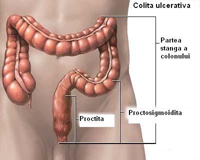 imagine cu colita ulcerativa